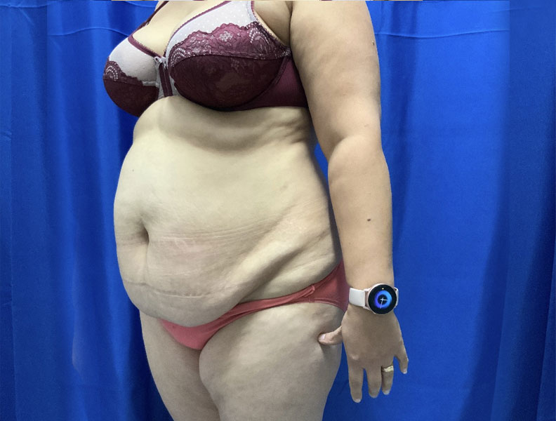 42 year old female 4 months after full abdominoplasty with liposuction of the upper abdomen and flanks