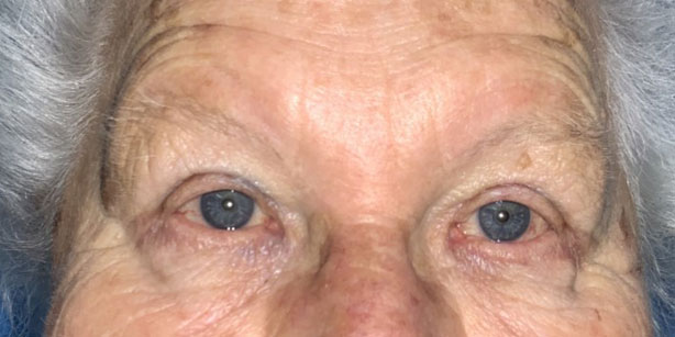 Patient3 upper blepharoplasty front after