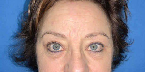 Patient2 upper blepharoplasty front after