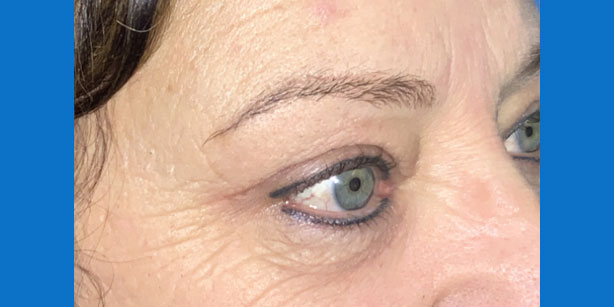 Patient2 upper blepharoplasty side after