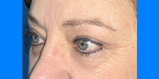 Patient2 upper blepharoplasty side after