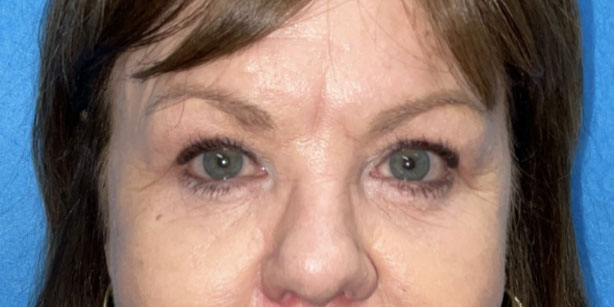 Patient1 upper blepharoplasty front after