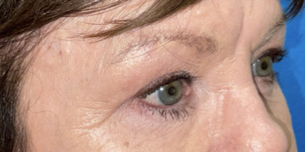 Patient1 upper blepharoplasty side after