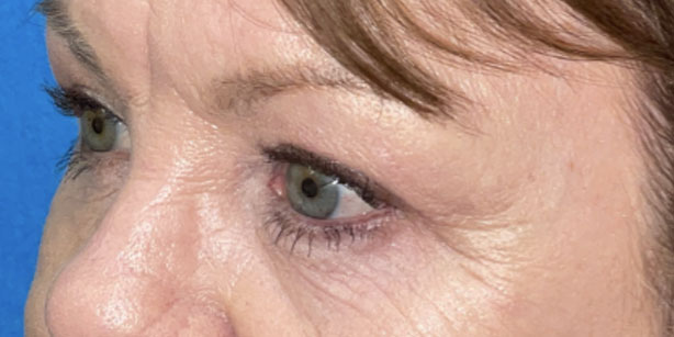 Patient1 upper blepharoplasty side after