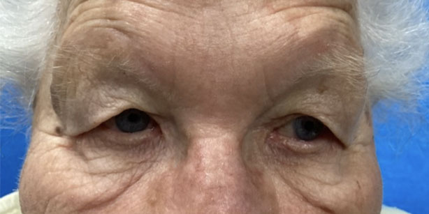 Patient3 upper blepharoplasty front before