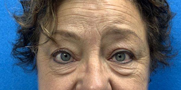 Patient2 upper blepharoplasty front before