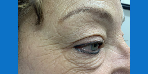 Patient2 upper blepharoplasty side before