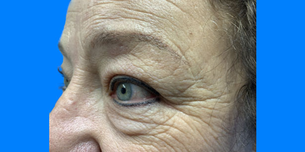 Patient2 upper blepharoplasty side before