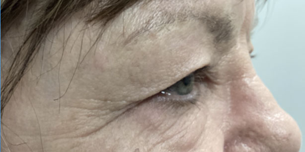 Patient1 upper blepharoplasty side before