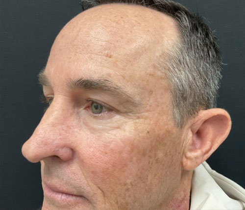 Before and 6 months after upper blepharoplasty and brow lift