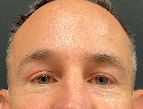3 months before and after endoscopic brow lift and upper blepharoplasty