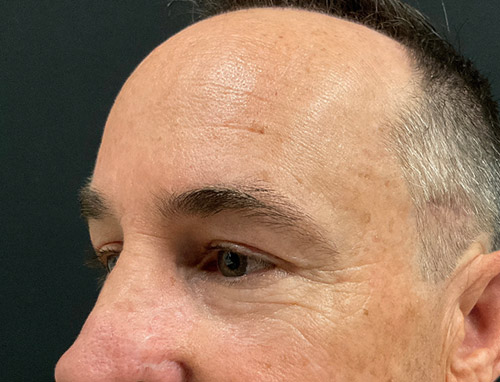 3 months before and after endoscopic brow lift and upper blepharoplasty 3 months before and after endoscopic brow lift and upper blepharoplasty