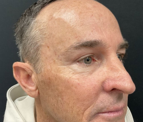 Before and 6 months after upper blepharoplasty and brow lift