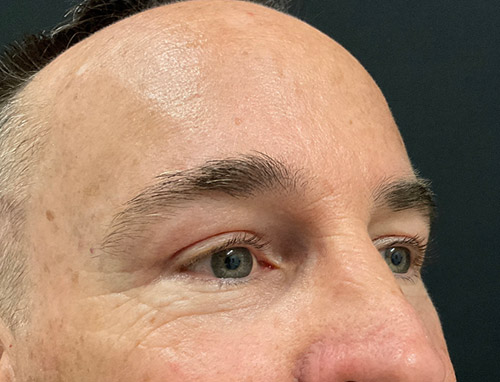 3 months before and after endoscopic brow lift and upper blepharoplasty 3 months before and after endoscopic brow lift and upper blepharoplasty