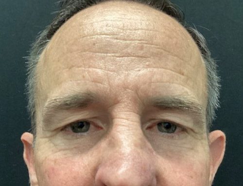 3 months before and after endoscopic brow lift and upper blepharoplasty 3 months before and after endoscopic brow lift and upper blepharoplasty