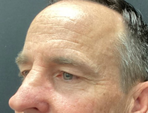 3 months before and after endoscopic brow lift and upper blepharoplasty 3 months before and after endoscopic brow lift and upper blepharoplasty