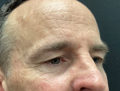 3 months before and after endoscopic brow lift and upper blepharoplasty 3 months before and after endoscopic brow lift and upper blepharoplasty