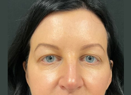 upper blepharoplasty patient before