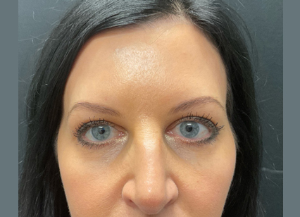 upper blepharoplasty patient after