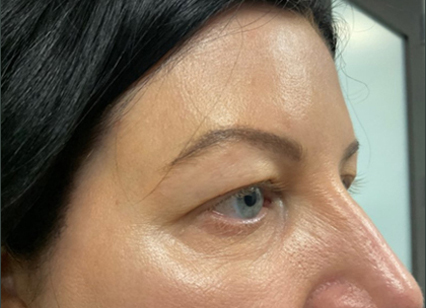 upper blepharoplasty patient before