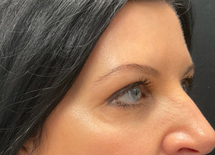 upper blepharoplasty patient after