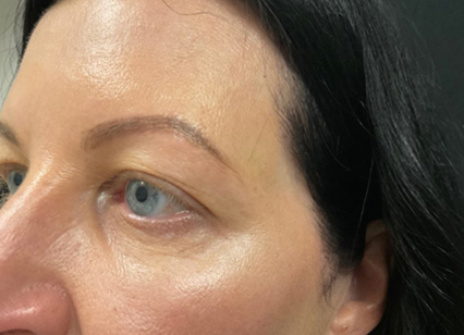 upper blepharoplasty patient before