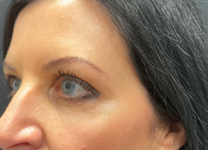 upper blepharoplasty patient after